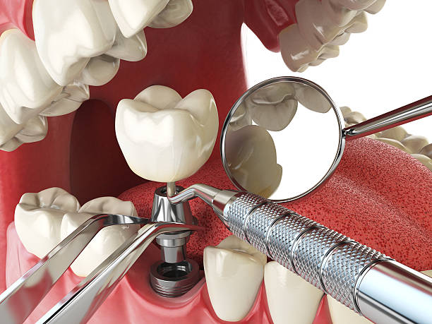 Best Emergency Tooth Extraction in Sappington, MO